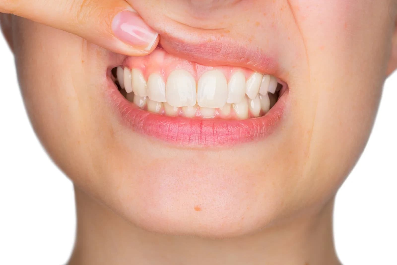 Zápal ďasien ako dôsledok nesprávnej ústnej hygieny